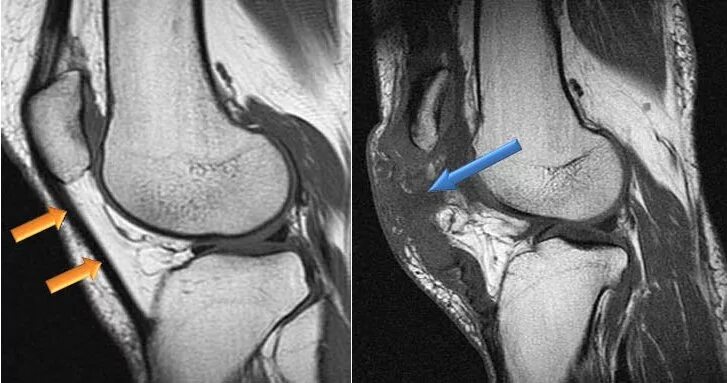 Разрыв связок коленного сустава симптомы фото Разрывы связки надколенника - Травмаорто
