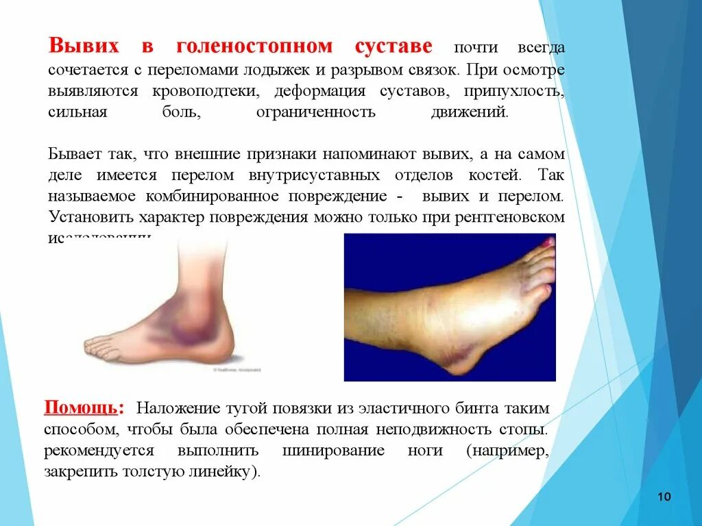 Разрыв связок стопы симптомы и лечение фото Что происходит при растяжении связок