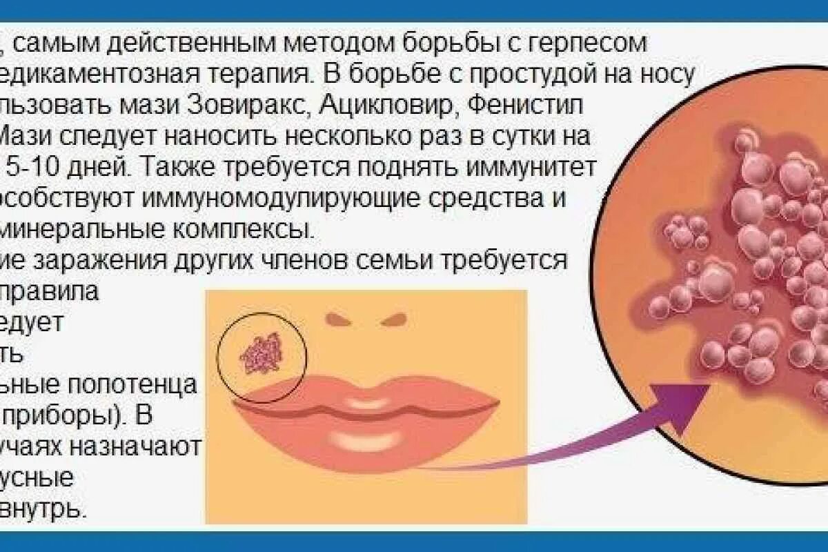 Развитие герпеса по дням фото Герпес у грудного ребенка: симптомы и лечение