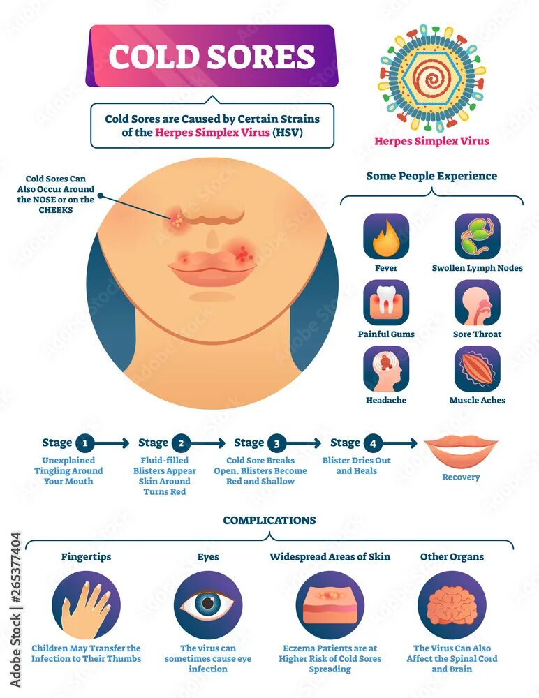 Развитие герпеса по дням фото Cold sores vector illustration. Medical labeled herpes simplex virus scheme Вект