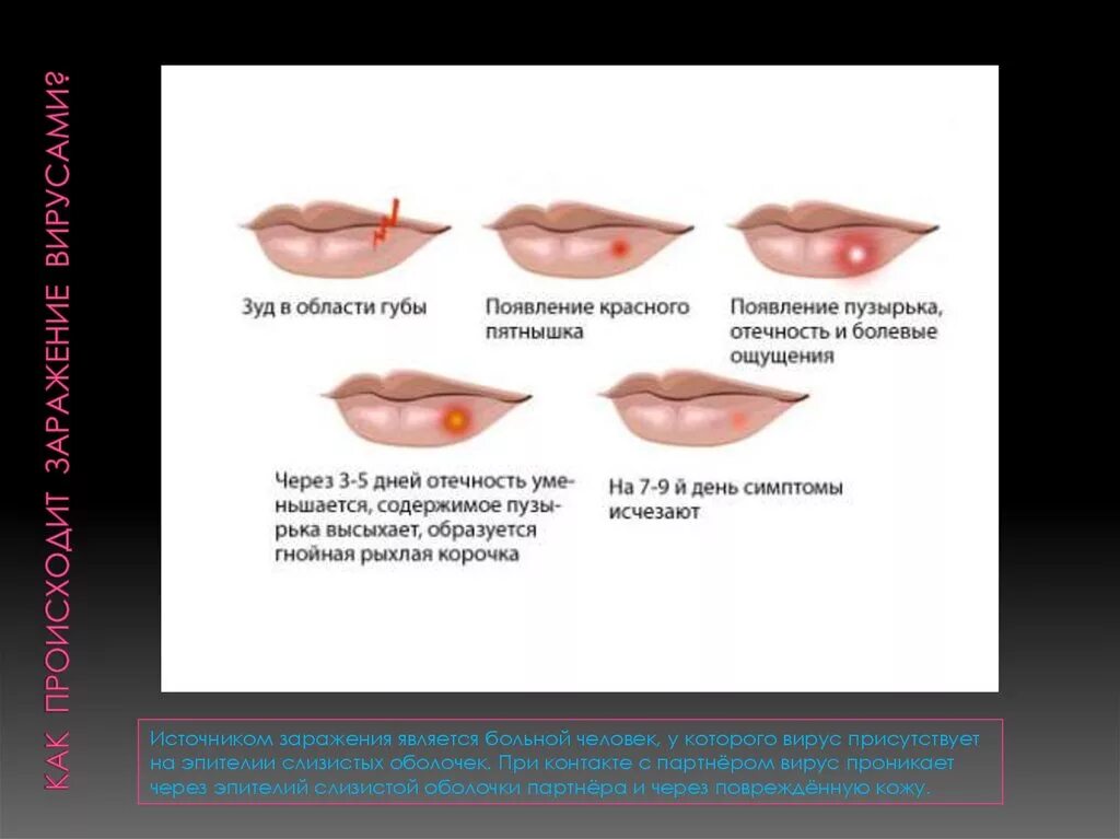 Развитие герпеса по дням фото Ге́рпес - презентация онлайн