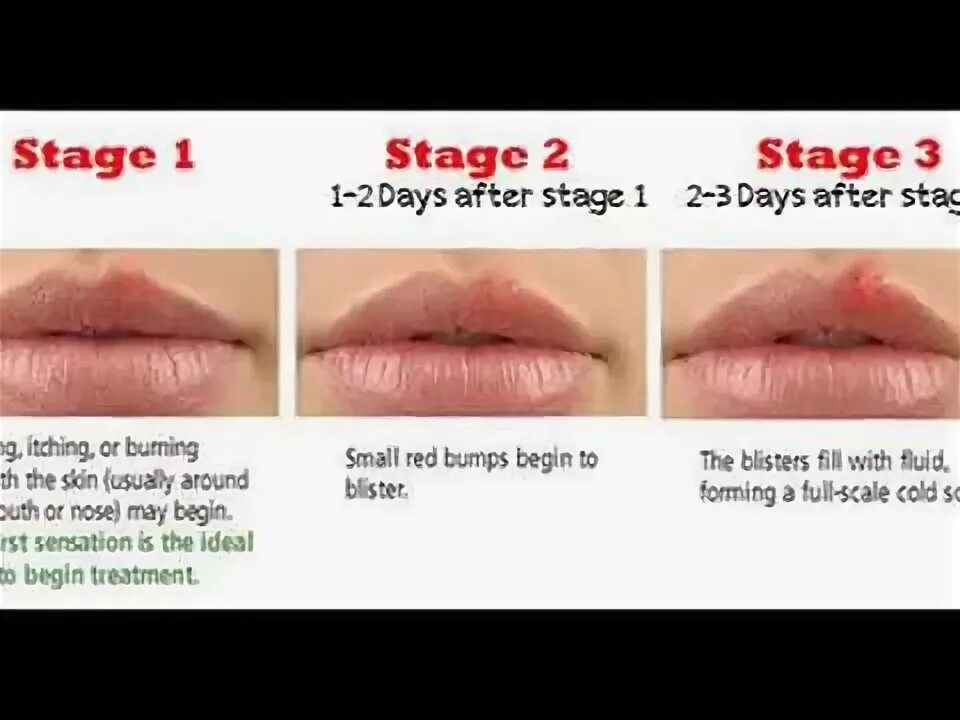 Развитие герпеса по дням фото The Ultimate Herpes Protocol - YouTube