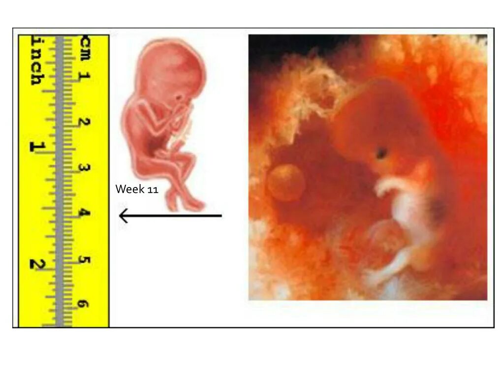Развитие плода 11 недель фото Плод по акушерским неделям - найдено 87 картинок