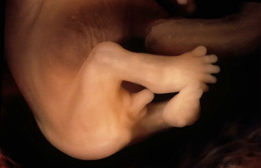 Развитие плода 11 недель фото Foetal Genitalia At 10 Weeks by Dopamine/science Photo Library