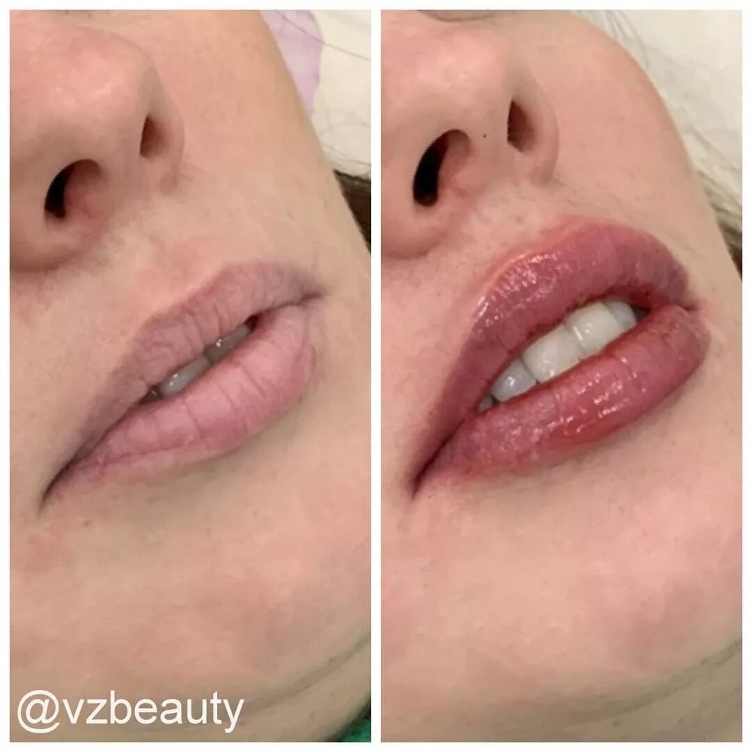 Разворот верхней губы ботоксом фото Увеличение губ 12.2019 - vzbeauty.ru