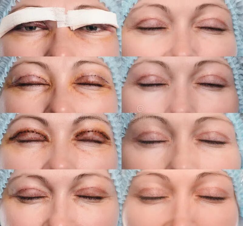 Реабилитация после верхней блефаропластики фото Blepharoplasty of the Upper Eyelid. Stock Image - Image of close, care: 89729957