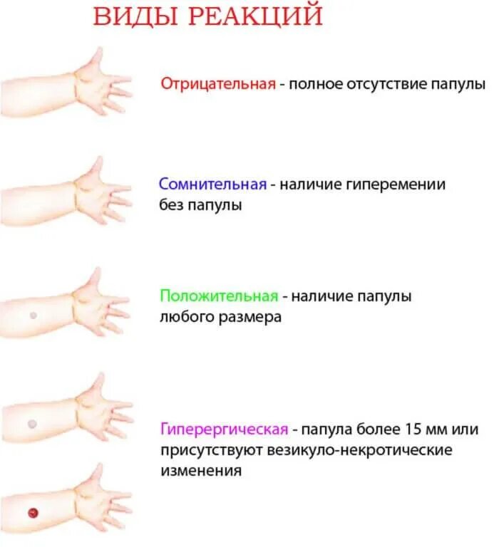 Реакция манту какая должна быть фото Делаем ''пуговку''. что такое проба манту? манту на туберкулез