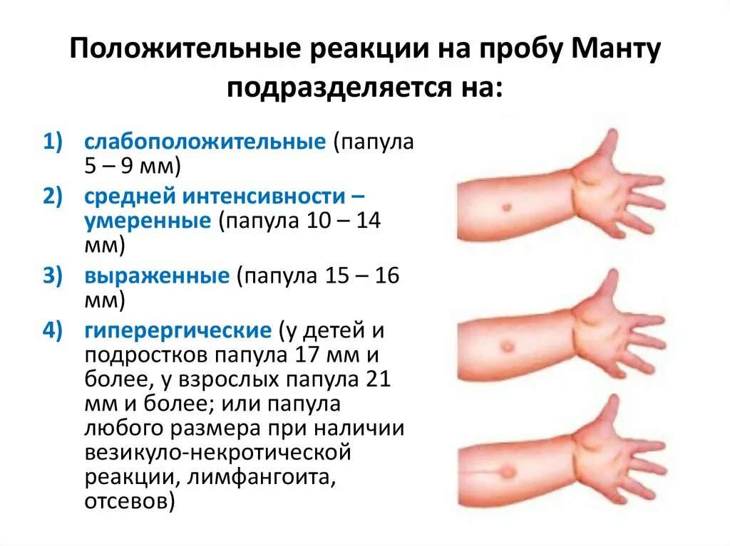 Реакция манту какая должна быть фото Повторная манту через сколько