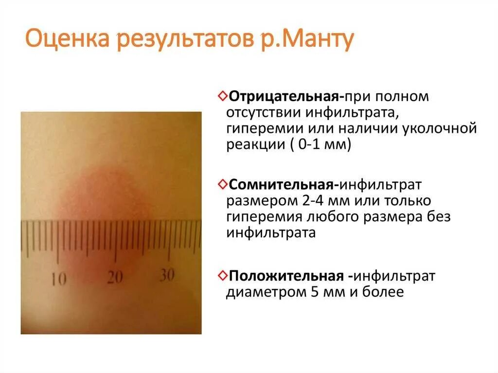 Реакция манту какая должна быть фото Проба манту детям в год