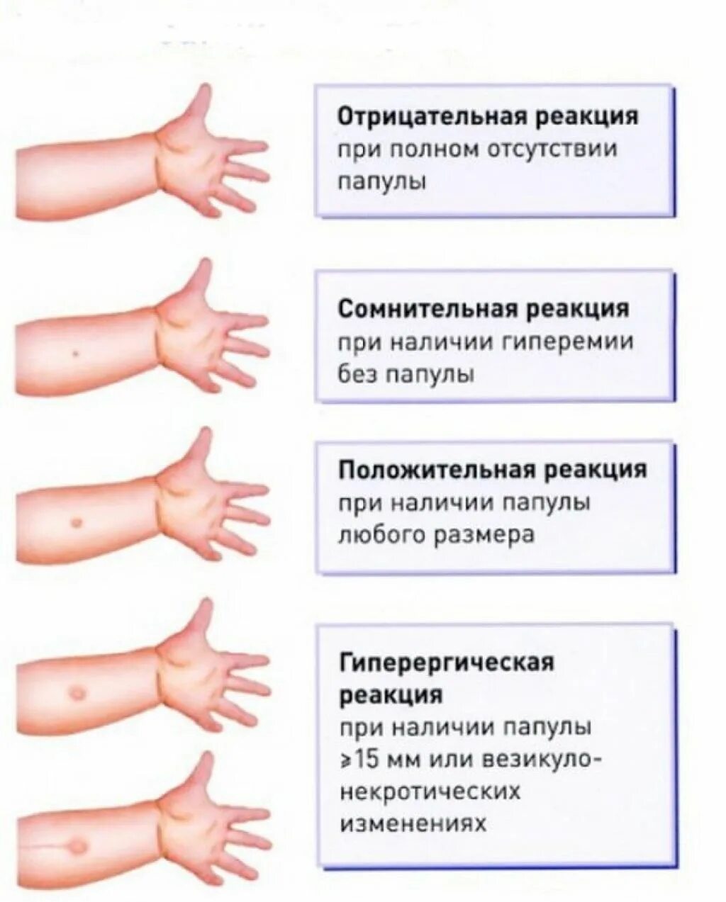 Реакция манту какая должна быть фото Реакция манту в год