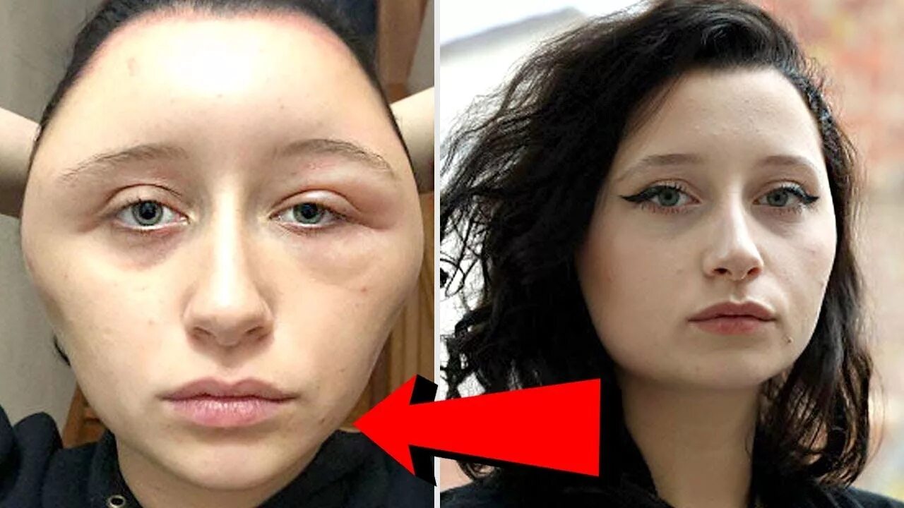 Реакция на фото бывшей Woman's Head Doubles In Size After Allergic Reaction To Hair Dye - YouTube