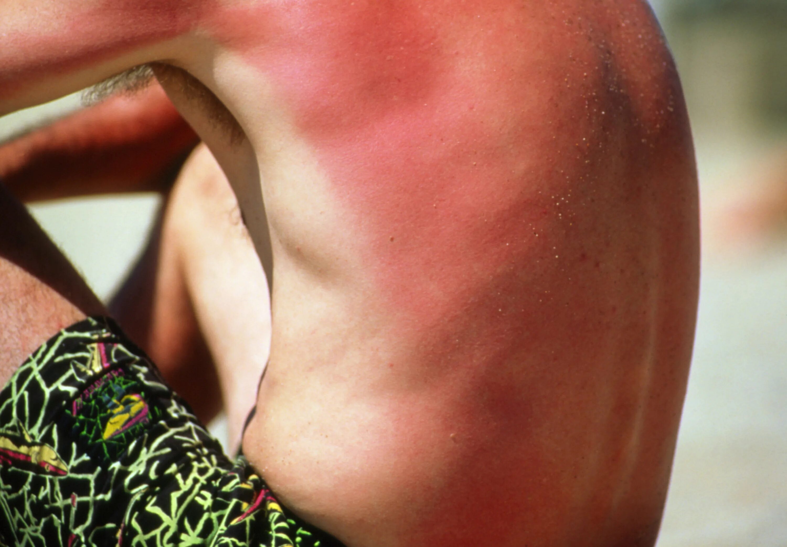 Реакция на солнце на коже фото Don’t pop blisters and NEVER put ice on your sunburn - 7 tips to ease the agony 