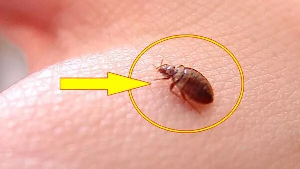 Ребенка покусали клопы фото Get Rid of Bed Bugs with this Effective Home Remedy