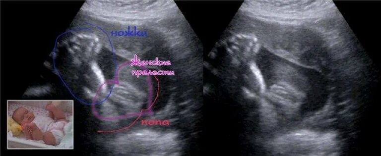 Ребенок 20 недель фото узи Отличия мальчика и девочки на фото по результатам проведенного УЗИ, общие черты 