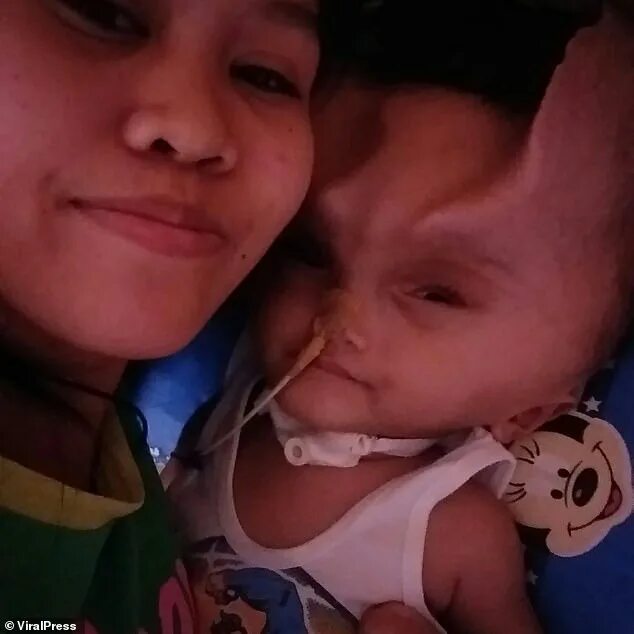 Ребенок родился без неба фото Toddler battling a rare brain condition is left with 'devil horns' Daily Mail On