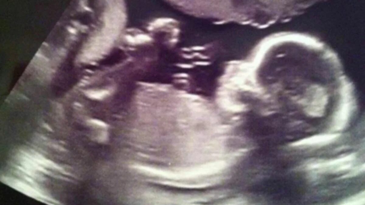 Ребенок в животе 20 недель фото Heartwarming picture shows 'angel' watching over unborn baby in ultrasound scan 