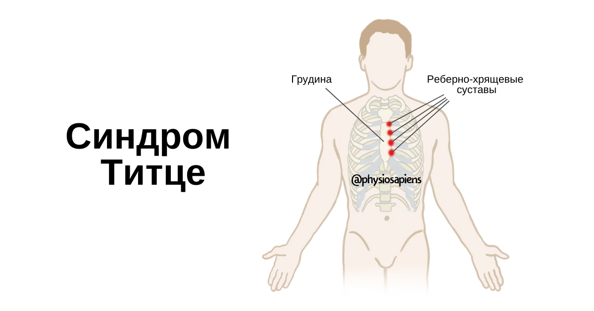 Реберный хондрит симптомы и лечение фото Заболела грудная клетка