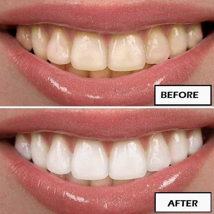 Редактор фото отбелить зубы Pin on Natural Teeth Whitening