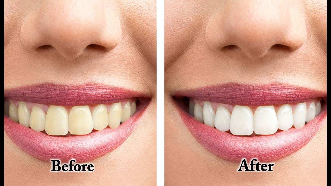 Редактор фото отбелить зубы How to Whiten Teeth Yellow Teeth with Braces Teeth Whitening at Home Baking Soda