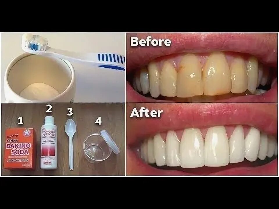 Редактор фото отбелить зубы Remedio para eliminar la placa dental y blanquear los dientes. Nuestra salud buc