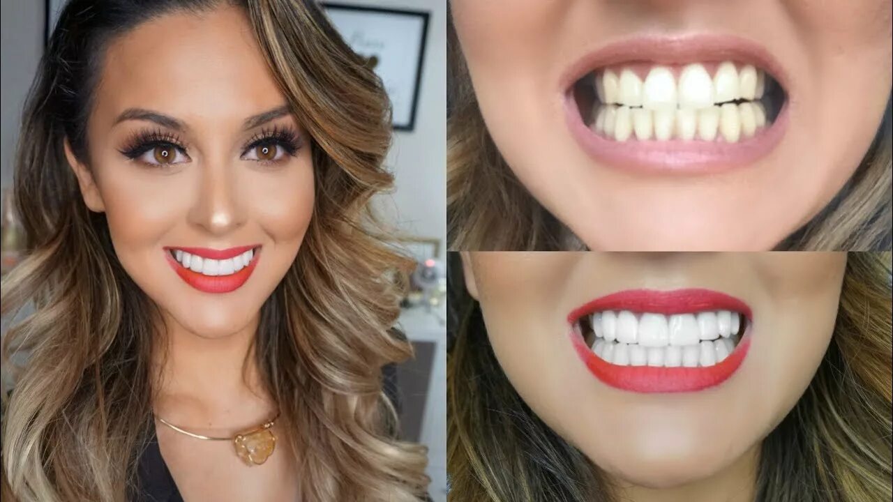 Редактор фото зубы My Teeth Transformation l Veneers Experience - YouTube