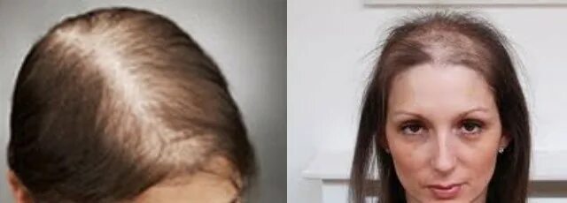 Редкие волосы фото женские Hair loss: what means will help to stop hair loss