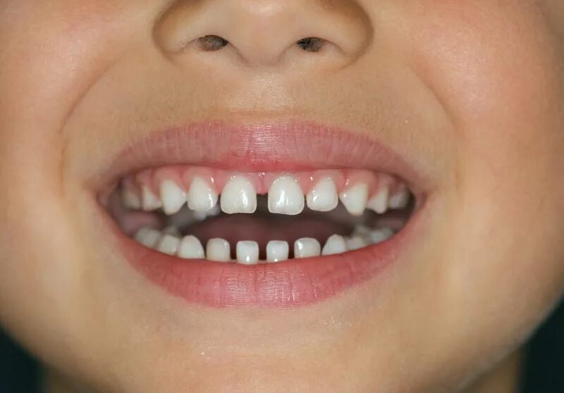 Редкие зубы фото Are spaces between baby teeth normal? - Non-Extraction Orthodontics