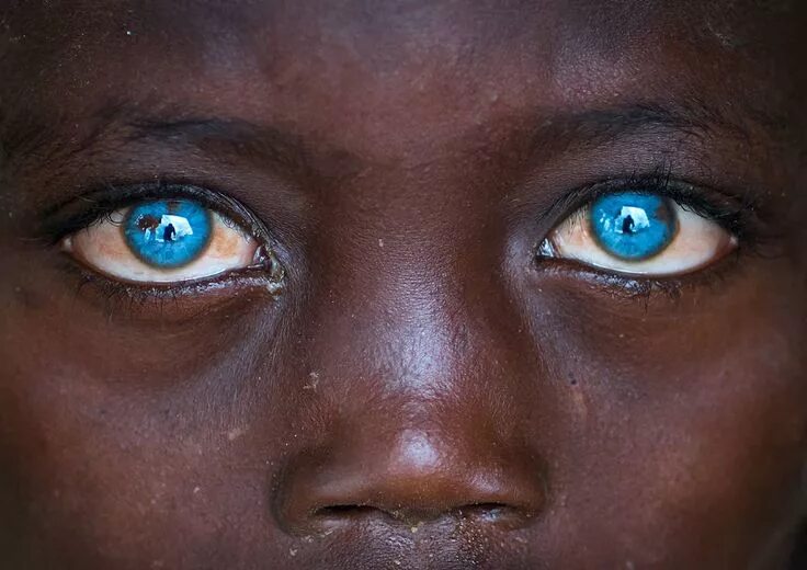 Редкий цвет глаз фото I Met Ethiopian Boy With The Plastic Eyes Blue eyes, Vibrant eyes, Rare eyes