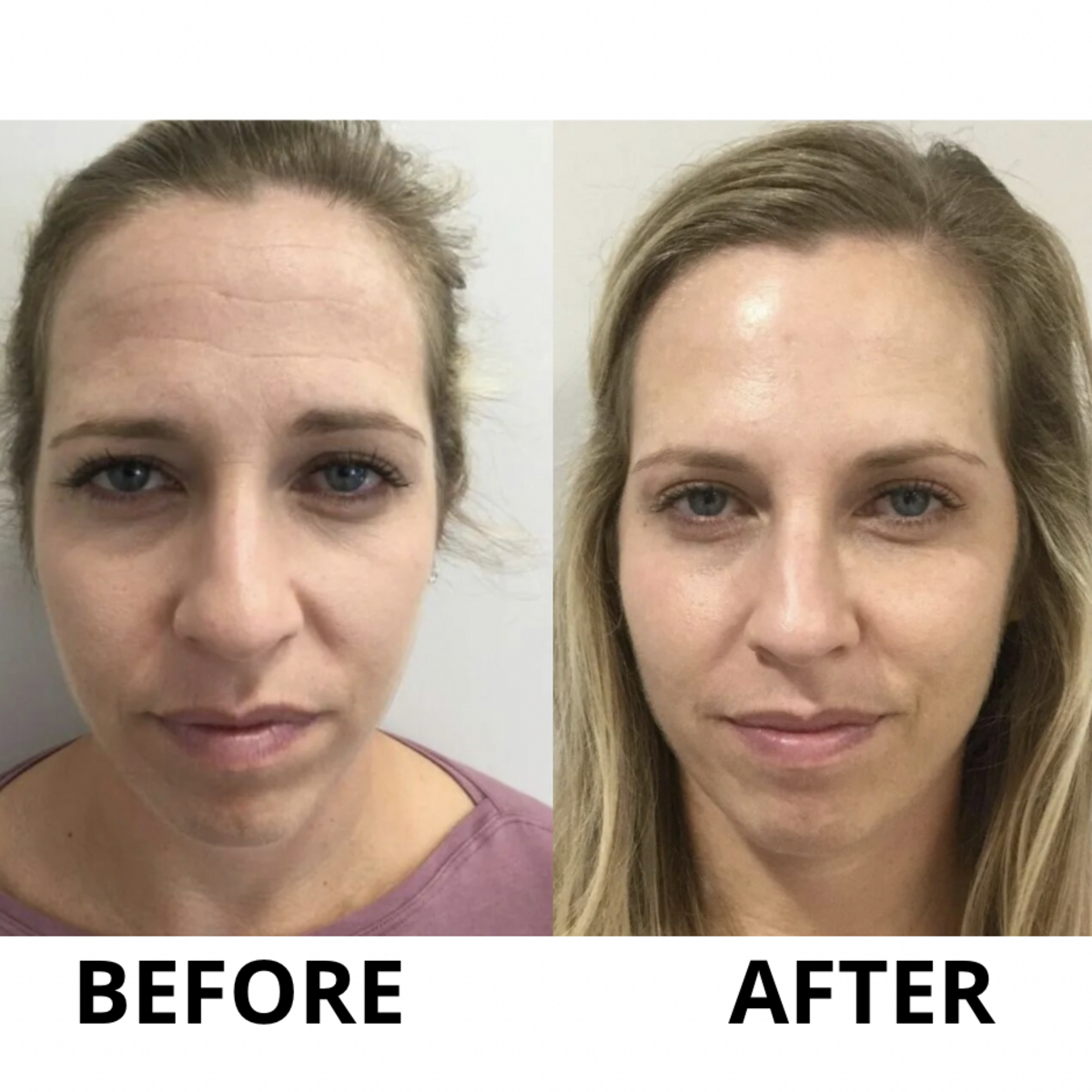 Реконструкция фото до и после Botox Injections (Before & After) - Faces Dataset Kaggle