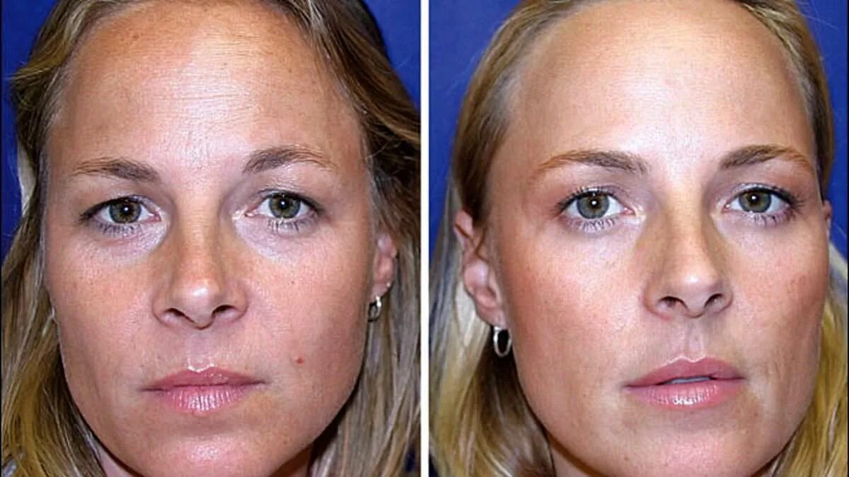 Реконструкция фото до и после One identical twin, 38, had Botox for 20 years - the other didn't. Who do YOU th