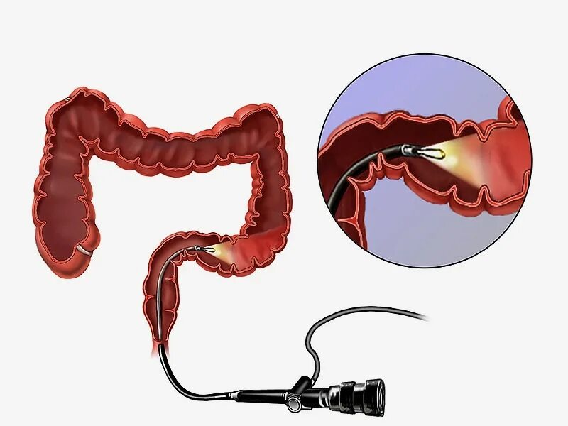 Ректороманоскопия при геморрое как выглядит Flexible Sigmoidoscopy Reduces All-Cause Mortality