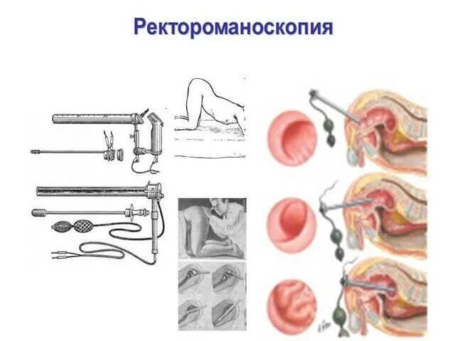 Ректороманоскопия при геморрое как выглядит Ректороманоскопия в СПб - цена, описание, отзывы