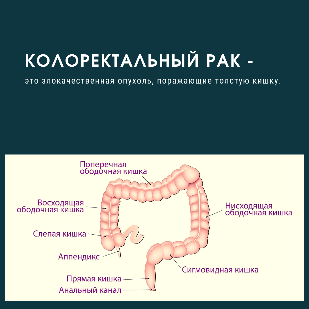 Ректосигмоидный отдел фото Рак толстой кишки. Какие симптомы? Когда и как выявить на ранней стадии. Дневник