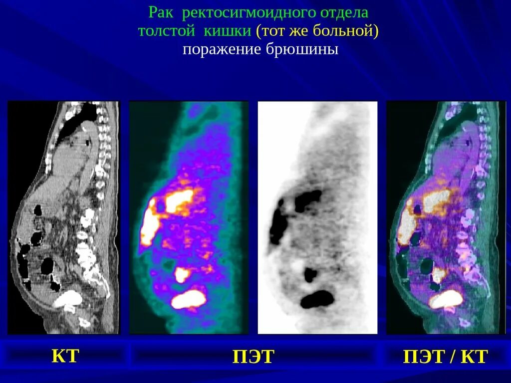 Фото ОБРАЗОВАНИЕ РЕКТОСИГМОИДНОГО ОТДЕЛА