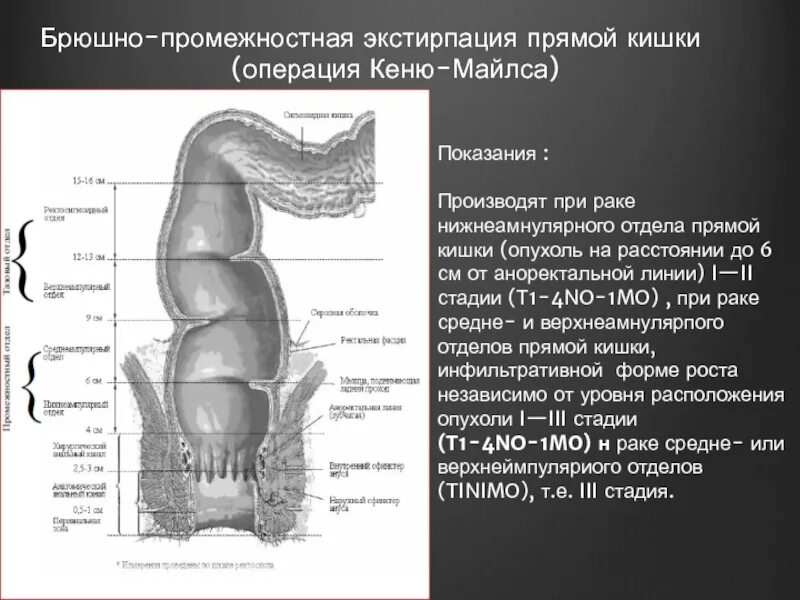 Ректосигмоидный отдел фото Определение прямой кишки: найдено 89 изображений