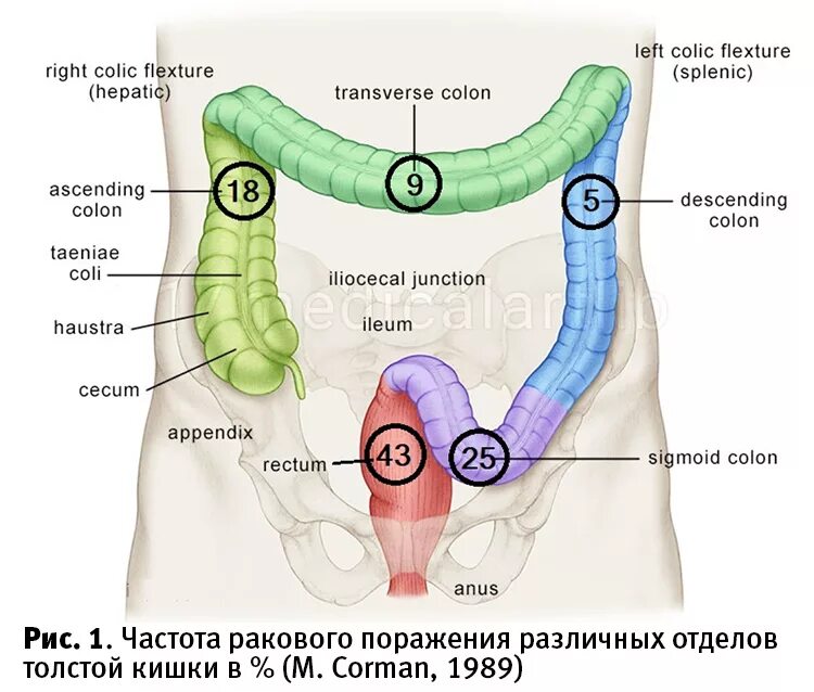 Ректосигмоидный отдел фото Extempore - Экстрагенитальная патология малого таза. Клинический случай выявлени