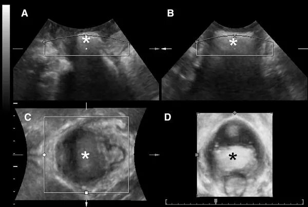 Ректоцеле что это такое фото Pelvic Floor Ultrasound: A Review - American Journal Of Obstetrics FAE