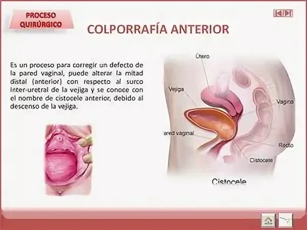 Ректоцеле что это такое фото Calaméo - Colporrafia Anterior Correccion Cistocele