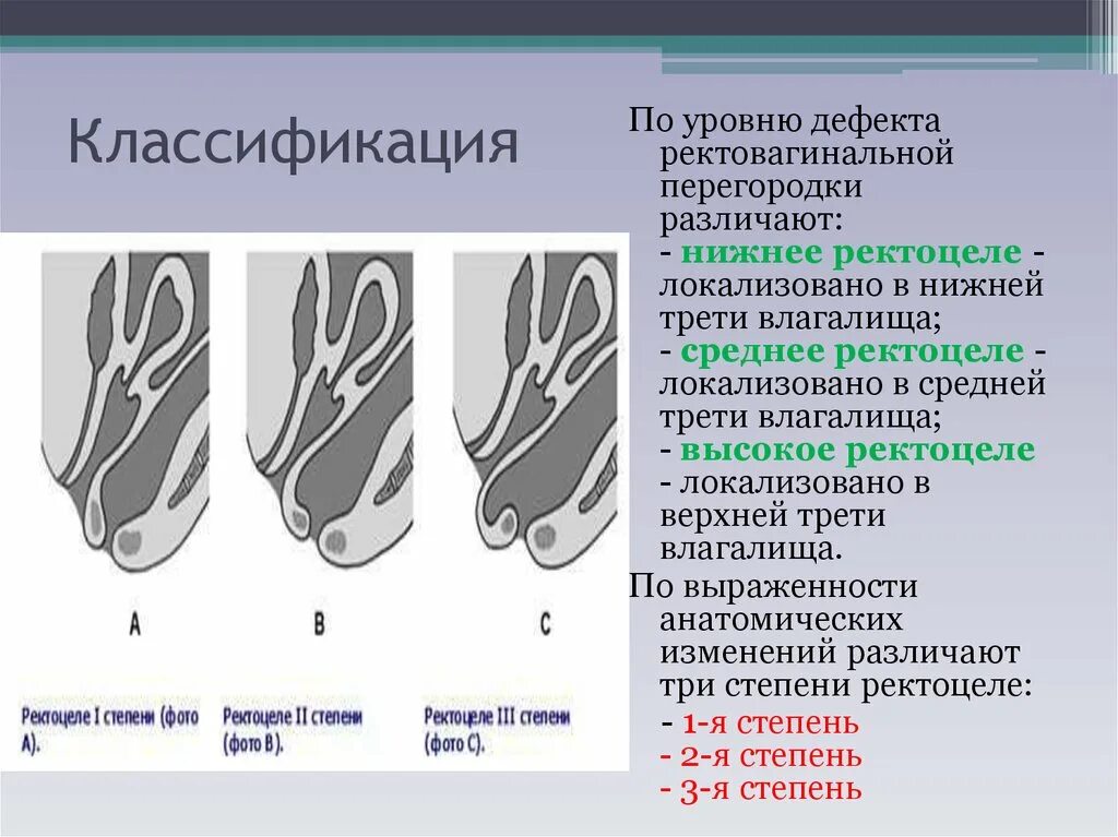 Ректоцеле что это такое фото Ректоцеле клинические рекомендации тесты с ответами