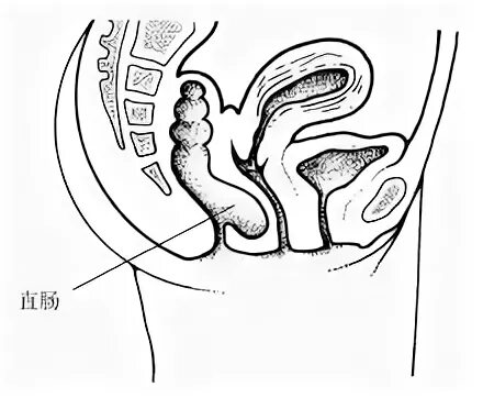 Ректоцеле что это такое фото Ректоцеле - Сторінки 3 - Всесвітній енциклопедичні знання