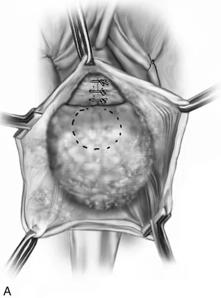 Ректоцеле что это такое фото Vaginal Repair of Cystocele, Rectocele, and Enterocele Clinical Gate