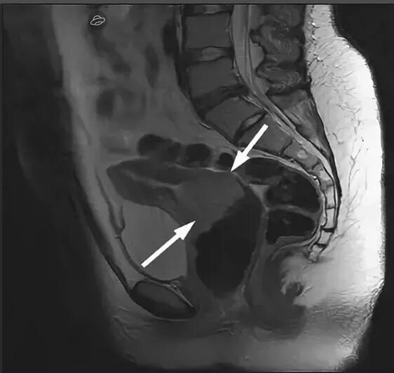 Can A Small Rectocele Be Treated At Home With Enema Factory Sale benzovoz.net