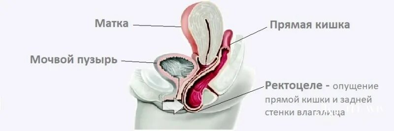 Ректоцеле что это такое фото Ректоцеле