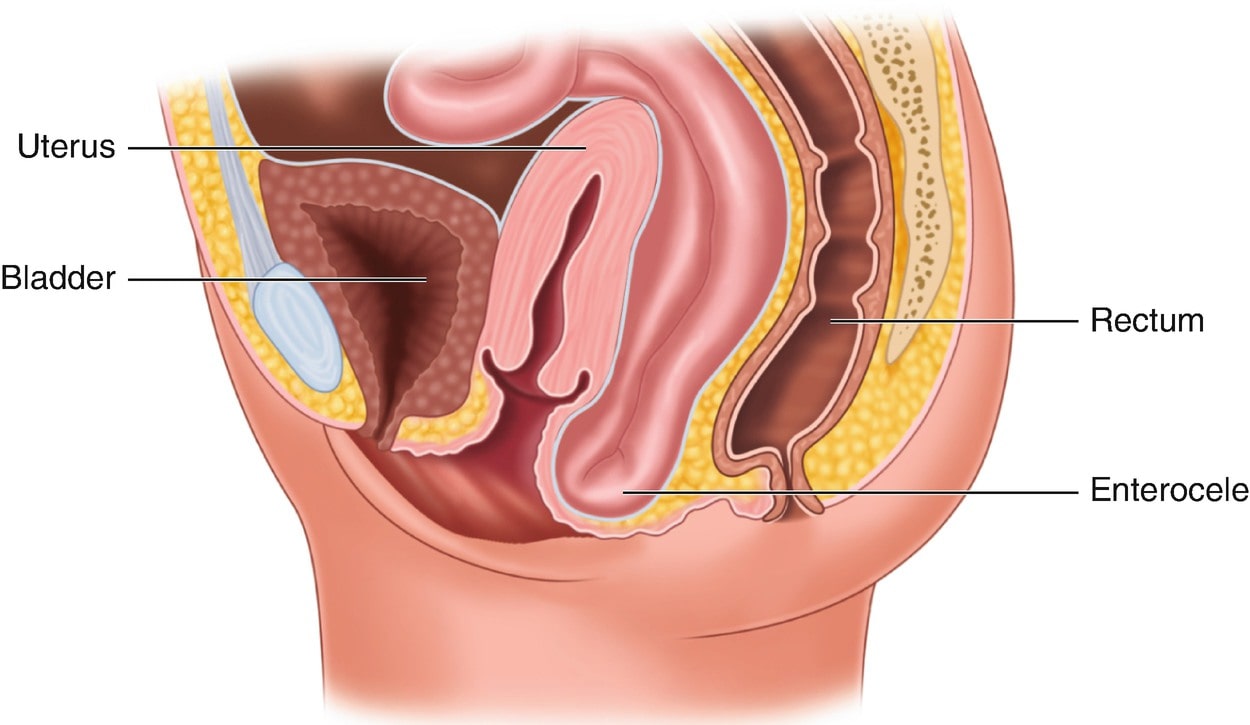 Ректоцеле что это такое фото Can A Small Rectocele Be Treated At Home With Enema Factory Sale benzovoz.net