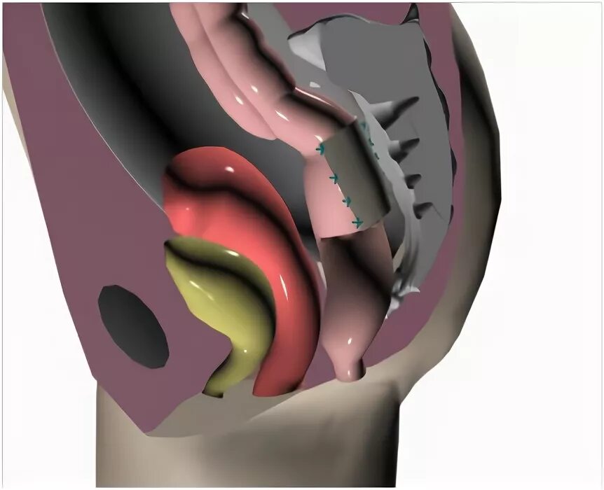Ректоцеле что это такое фото Лечение выпадения прямой кишки с помощью лапароскопических операций - уникальные