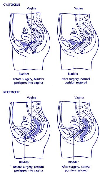 Ректоцеле что это такое фото Mr Michael Stafford Private Gynaecologist Consultant Pregnancy Control London