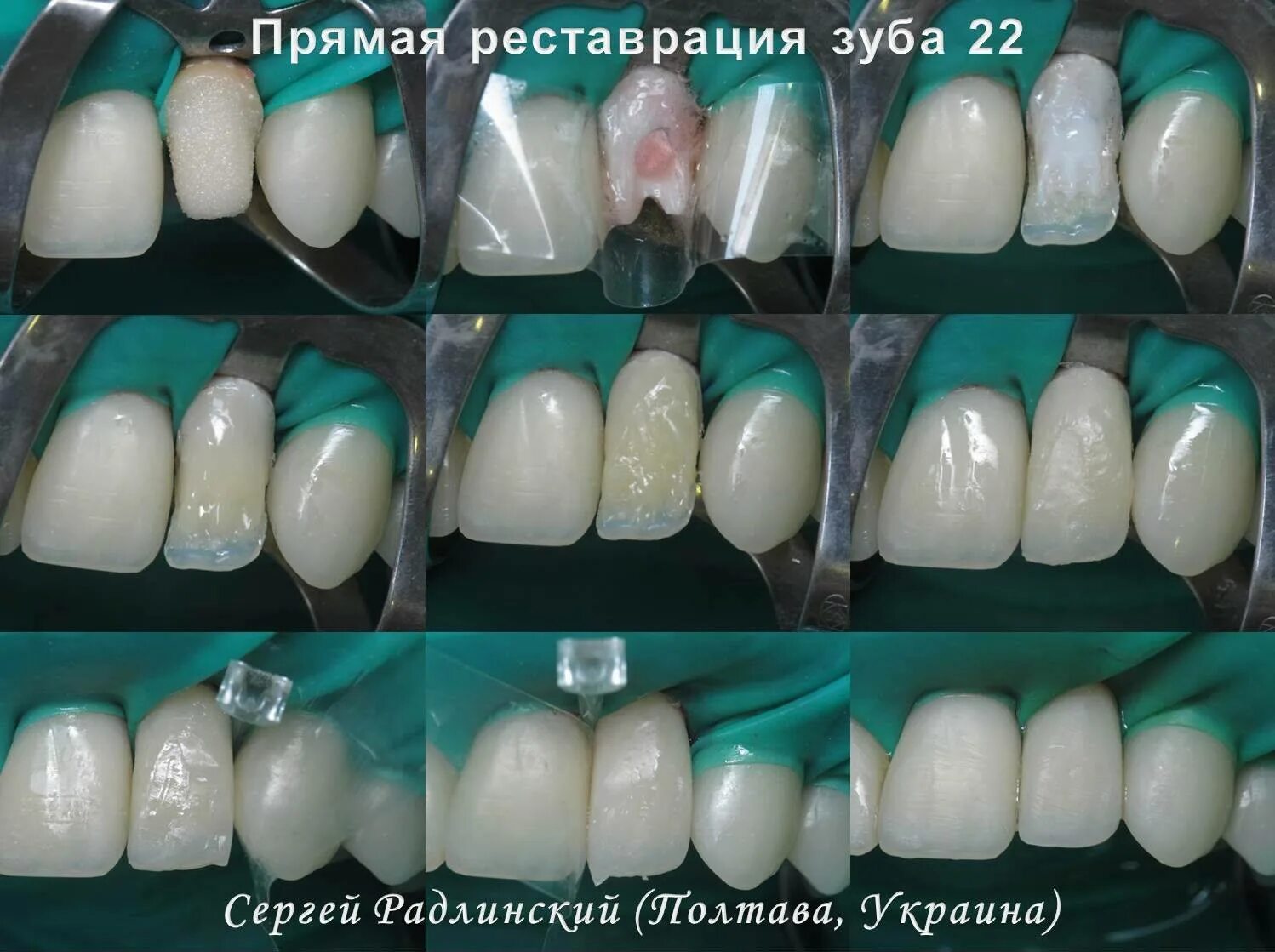 Ремонт зубов своими руками Dental-Revue Фотогалерея Клинический случай № 35: прямые композитные реставрации