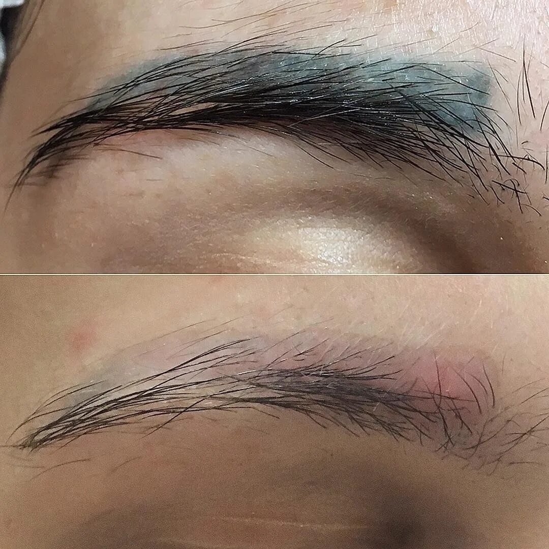 Ремувер для удаления татуажа бровей отзывы LASER or REMOVER? If we are talking about removing gray, blue, purple, gray shad