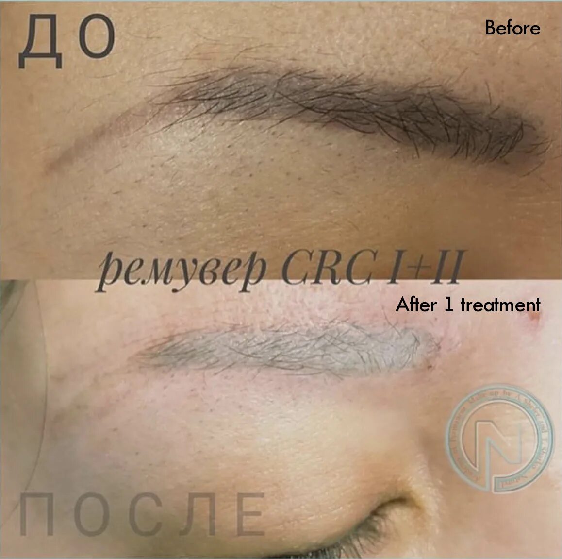 Ремувер фото до и после Работы мастеров CRC Tatoo Remover I+II