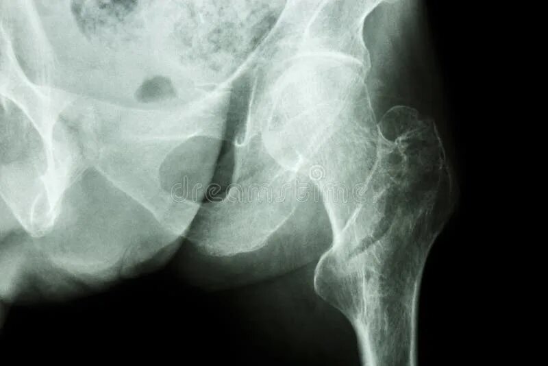 Рентген бедренной кости фото Intertrochanteric Fracture Femur Thigh Bone . X-ray of Hip and Comparison betwee